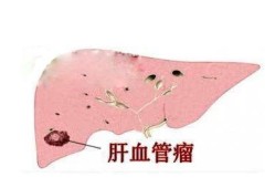 胎儿肝脏血管瘤怎么办,如何预防胎儿血管瘤形成原因