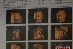 胎儿系统彩色多普勒超声检查是什么意思,胎儿系统b超查什么项目