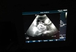 32周胎儿胆囊正常值（32周胎儿胆囊正常值是多少毫米）