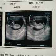 胎儿仰头（胎儿仰头对nt影响）
