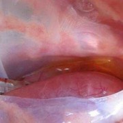 胎儿心包积液生下来了（胎儿心包积液生下来了怎么样）