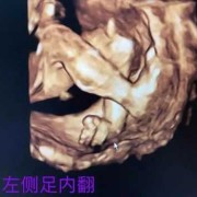 担心胎儿脸上有胎记（四维彩超能不能看出胎儿脸上是否有胎记）