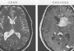 胎儿左右脑室不对称（胎儿左右脑室不对称）