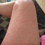为什么孕妇腿上会长妊娠纹,孕期大腿有纹路