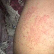 孕妇腿上起红疙瘩还很痒要怎么办,孕期大腿痒是怎么回事
