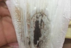 孕期鲜血（怀孕出血褐色变鲜红怎么办呀？这是不是严重了，胎儿还能保住吗）