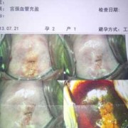 孕期宫颈检查（宫颈切片检查是什么）
