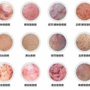 孕期痘痘（孕期痘痘反反复复长的原因是什么）