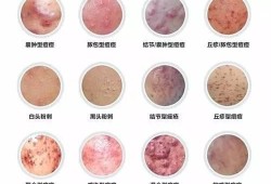 孕期痘痘（孕期痘痘反反复复长的原因是什么）