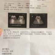 孕囊积液跟拉肚子有关吗,胎儿肠管积液是什么意思