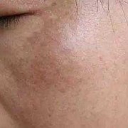 孕妇脸上长斑是怎么回事,孕期脸上长斑怎么去除小妙招