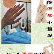 孕期的湿疹怎么办啊（孕妇湿疹怎样快速止痒有什么好的办法的吗，快要用湿疹药膏的吗）