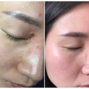 孕期能去痣吗（孕期能去痣吗有影响吗）