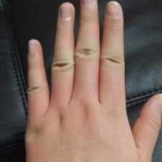 孕期手肿（孕期手肿胀握拳有紧绷感觉）