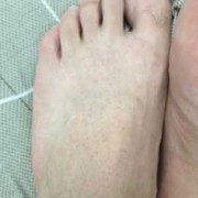 孕期脚面痒的难受怎么办,孕期脚面疼是怎么回事