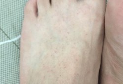孕期脚面痒的难受怎么办,孕期脚面疼是怎么回事