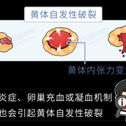 什么是黄体破裂,孕期黄体破裂是怎么回事