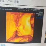 胎儿兔唇四维彩超图片（兔唇彩超能看出来吗）