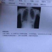 胎儿肺积水（胎儿肺积水是怎么引起的）