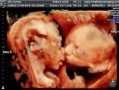怀孕32周胎儿入盆了吗（怀孕32周胎儿入盆了吗）