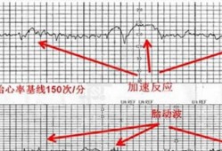 男孩和女孩心跳声音的区别,孕期胎儿心跳判断男女准吗