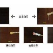 孕期白带黄绿色是怎么回事,孕期黄绿色分泌物是怎么回事