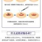 母乳喂奶乳头破皮流血了怎么办,孕期乳晕破皮流水抹乳汁有用吗