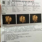 孕期三维彩超（三维彩超什么时候做）