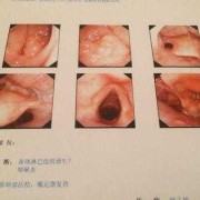 怀孕了老是感觉喉咙里有东西是怎么回事,孕期喉咙痛怎么解决