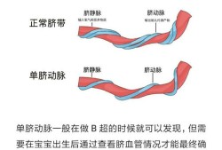 孕12周了检查宝宝是单脐动脉是怎么回事,胎儿单血管怎么回事