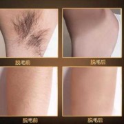 孕期激光脱毛（孕期激光脱毛对胎儿有影响吗）
