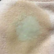 怀孕后分泌物是黄色,孕期分泌物黄色正常吗