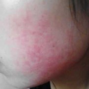 怀孕了皮肤过敏很痒怎么办,怀孕期间过敏了怎么办啊