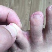 怀孕期间有脚气怎么治（怀孕期间有脚气怎么治疗好）
