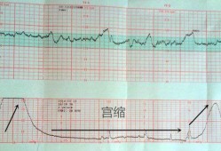 心电图对胎儿有影响吗（胎儿超声心动图一定要做吗?需要注意什么呢）
