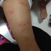 怀孕期腿痒是男孩（怀孕期腿痒是男孩）