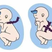 胎儿挤带绕颈怎么办（孕宝宝脐带绕颈怎么办？脐带绕颈对胎儿有什么坏处）