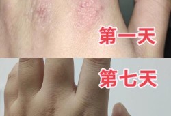 孕期手上起湿疹怎么办（手指上长像湿疹，透明小疹子，能用醋泡手吗）