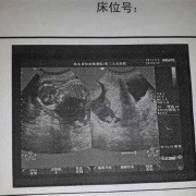 胎儿没胎心有什么征兆（胎儿没胎心有什么征兆吗）