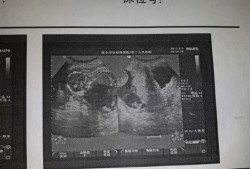 胎儿没胎心有什么征兆（胎儿没胎心有什么征兆吗）