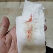 孕24周内检没有出血小便后还是有血是怎么回事,怀孕期间见红是什么原因导致的