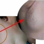孕妇腋下淋巴结肿大怎么办,孕期腋窝淋巴结肿大怎么回事