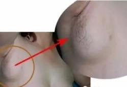 孕妇腋下淋巴结肿大怎么办,孕期腋窝淋巴结肿大怎么回事