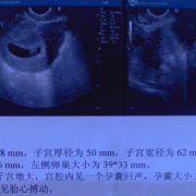 b超胎儿憋尿（怀孕6周时做B超检查需要憋尿吗）