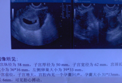 b超胎儿憋尿（怀孕6周时做B超检查需要憋尿吗）