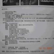 胎儿肾积水怎么办（怀孕胎儿肾积水怎么办）