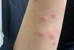 孕期丘疹性荨麻疹（丘疹型荨麻疹该怎样治疗）