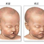唇腭裂是怎么造成的,胎儿唇腭裂能修复吗