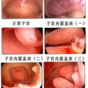 孕期宫颈息肉如何治疗,孕期如何让息肉不出血 偏方