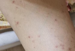 怀孕期间湿疹怎么办（孕妇得湿疹怎么治）